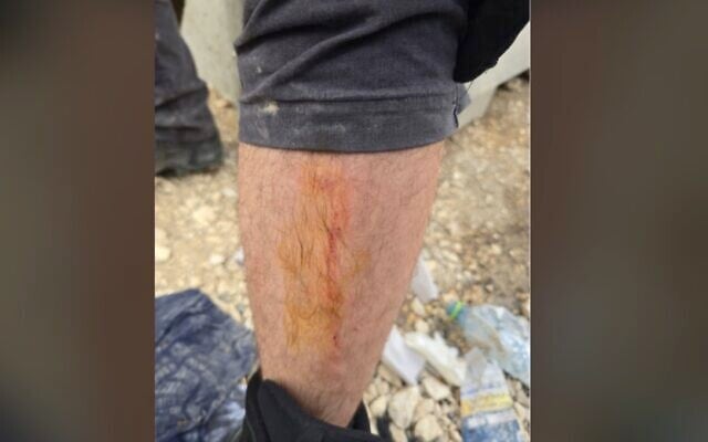 A police officer's leg after he was bitten by a demonstrator during the dispersal of an ultra-Orthodox protest on March 19, 2026. (Israel Police)